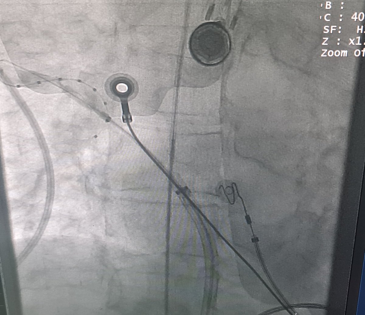 @nicvd_karachi, our atrial fibrillation ablation program continues. Early treatment results in improved quality of life.
#SucessStories #freeofcostTreatment