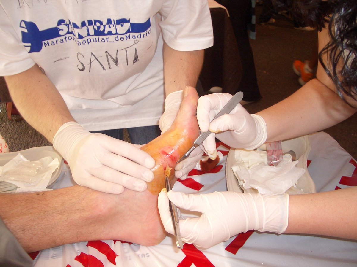 🔵 NUEVO POST EN EL BLOG 🔵

✍️ Hoy os hablo de una lesión que pocas presentaciones necesita: las ampollas. Os cuento por qué aparecen, los factores que influyen, cómo prevenirlas y el tratamiento necesario. 

⬇️⬇️⬇️
angeldelarubia.es/ampollas-orige…

#podologia #podologo