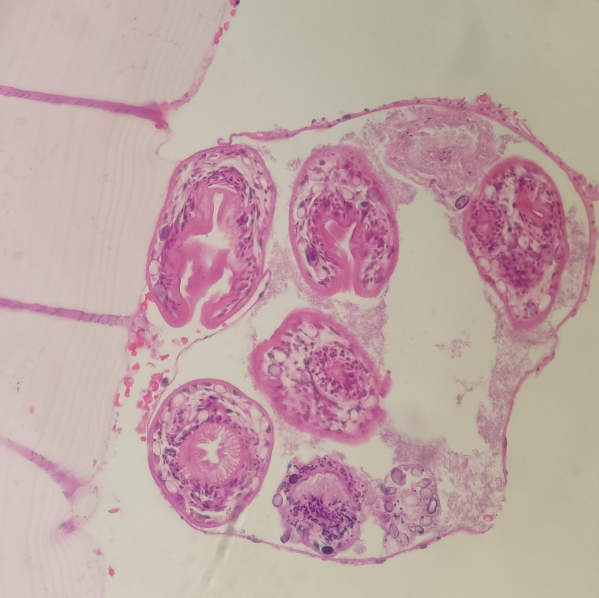 He_yakup's tweet image. #hydatidcyst #pathology #pathbugs