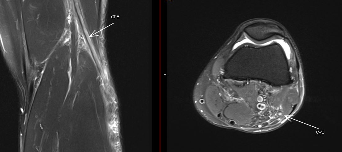 PepeL (@pepelermarx) on Twitter photo External popliteal sciatic nerve damage associated with ACL complete tear and posterolateral corner of the knee injury (avulsion of fibular collateral ligament + biceps femoris tendon)
<a href="/SermeMsk/">Casos de #radiología #MSK de la #SERME</a> <a href="/MskSerme/">SERME</a> <a href="/drwillyjara/">Willy Fernández Jara</a> <a href="/akassarjian/">Ara Kassarjian, MD, FRCPC</a> <a href="/MadridBoneClub/">MadridBoneClub</a> <a href="/JM_Zulueta_O/">JM ZuluetaOdriozola</a>
#mskradiology External popliteal sciatic nerve damage associated with ACL complete tear and posterolateral corner of the knee injury (avulsion of fibular collateral ligament + biceps femoris tendon)
<a href="/SermeMsk/">Casos de #radiología #MSK de la #SERME</a> <a href="/MskSerme/">SERME</a> <a href="/drwillyjara/">Willy Fernández Jara</a> <a href="/akassarjian/">Ara Kassarjian, MD, FRCPC</a> <a href="/MadridBoneClub/">MadridBoneClub</a> <a href="/JM_Zulueta_O/">JM ZuluetaOdriozola</a>
#mskradiology