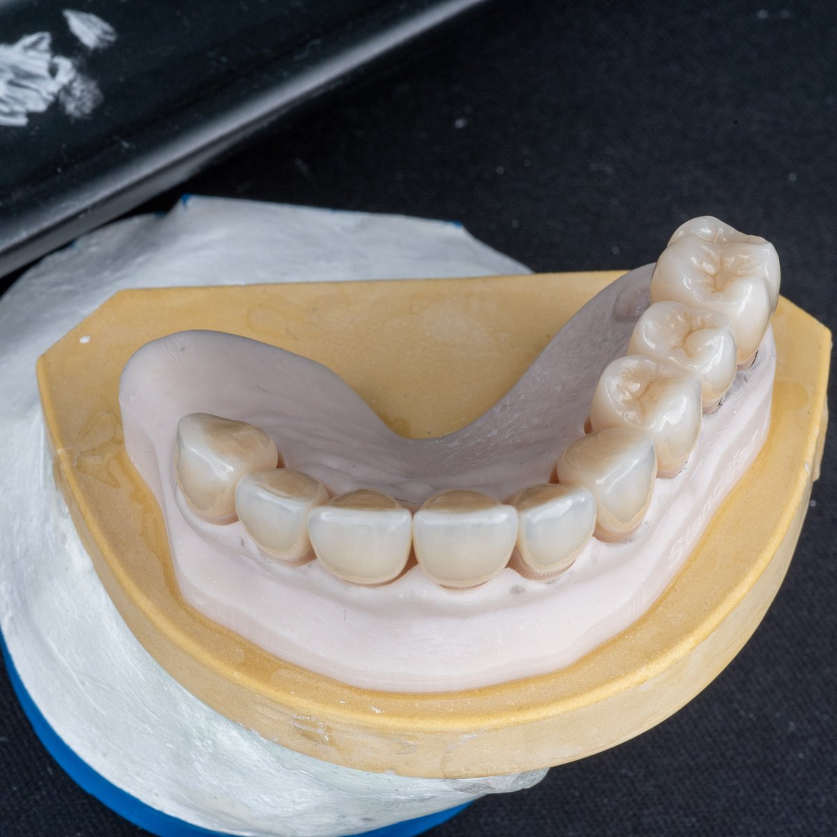 AdamRut9260's tweet photo. Check out this stunning full maxillary rehabilitation using Noritake Katana YML zirconia! Our Exocad Grand Prize winner, Issak Combria, designed the case and our expert ceramist Andres Vega finished it to perfection. #noritakekatana #exocad #cosmeticdentistry #smilemakeover https://t.co/ETZbXZQsfE