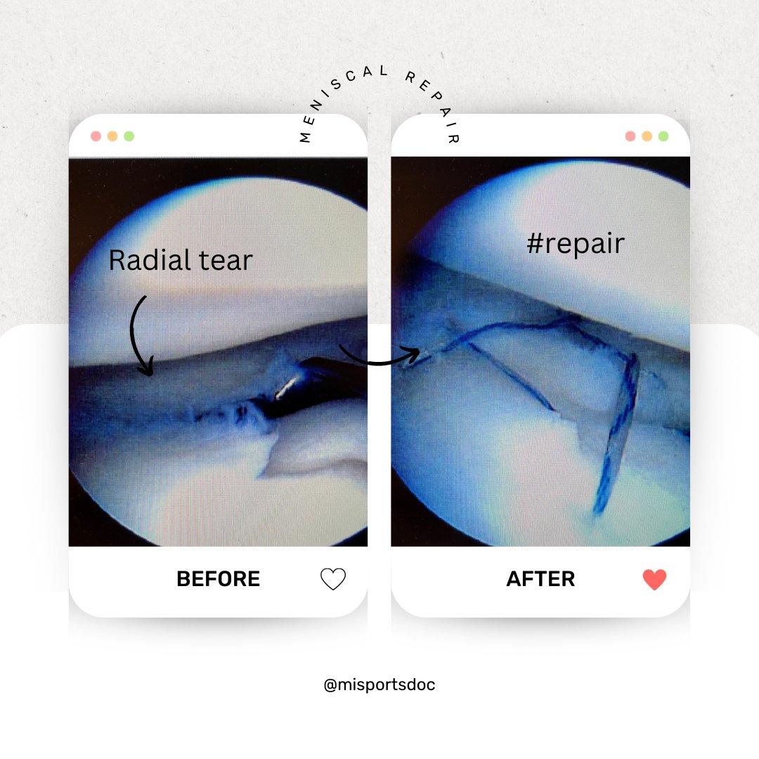misportsdoc's tweet photo. Social media uses # so do we with this technique in the kneeMeniscal tears are a very common cause of knee pain. Technology is expanding and the meniscus is vital to proper function of the knee. #savethemeniscus#orthopedics #michigan #kneepain #meniscustear #meniscus https://t.co/eeYnHgohWv