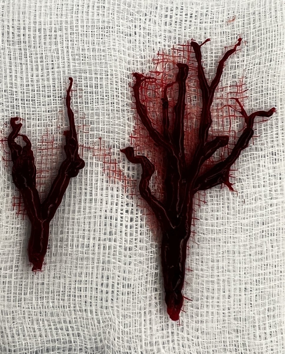 'Bloody swell' - 'A rush of blood' in the lungs!

#BronchoscopicThrombectomy - All'swell that ends well!!

#WorldBronchoscopyDay #March30th