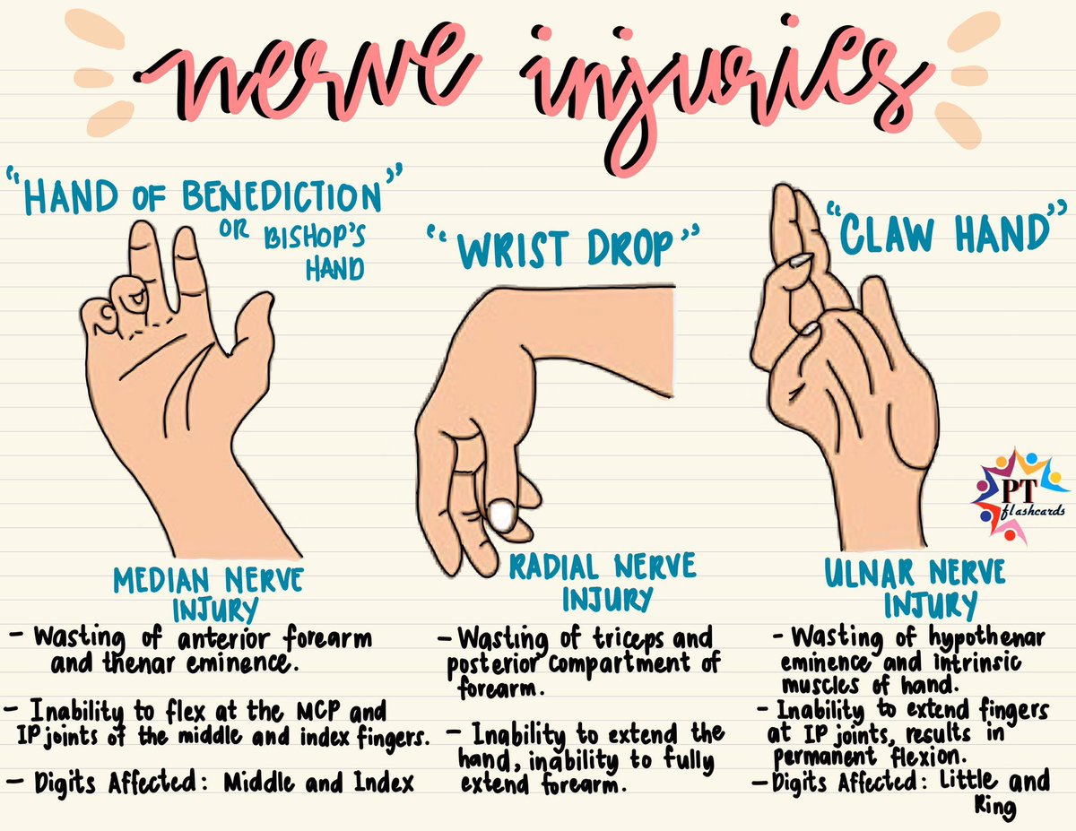 Medical_MD1's tweet photo. Hand nerve lesions ✨

Way to remember them easily 😉👌🏼

Use this 👉🏼 Dr. CUMA 🧑🏾‍⚕️

DR 👉🏼 “D”rop wrist = “R”adial
CU 👉🏼 “C”law hand = “U”lnar
MA 👉🏼 “M”edian nerve = “A”pe hand

- https://t.co/xyATaMmbAi