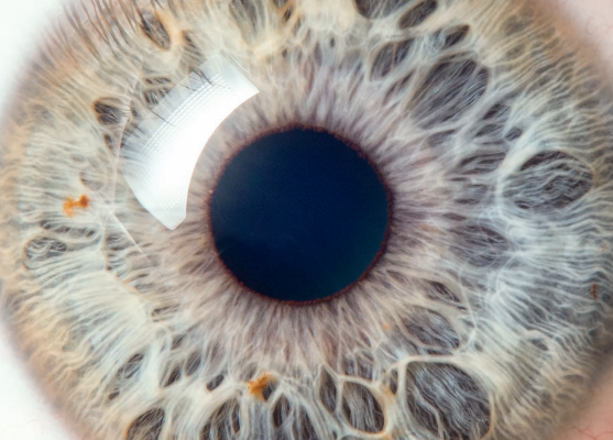 hug_ge's tweet photo. Dans certains cas, le recours à la chirurgie est indispensable dans la prise en charge du strabisme pour agir sur les muscles oculaires et améliorer le confort visuel ou l’aspect esthétique #strabisme #chirurgie #ophtalmologie #oeil https://t.co/fb8yR1nGLN https://t.co/RYrQZd3ZKq
