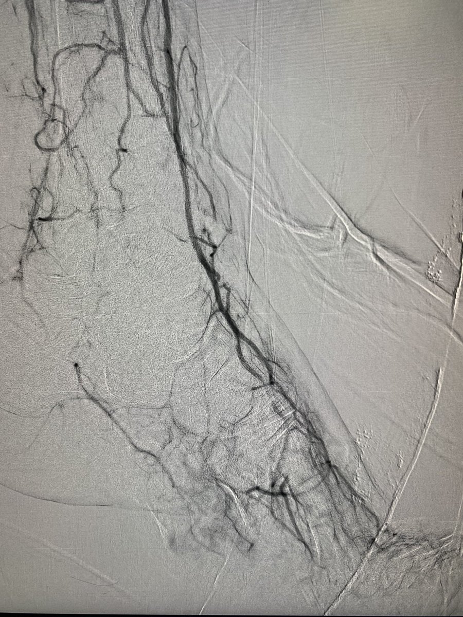 #CLI with occluded #ATA and #PTA , big toe #gangrene , single run off through #peroneal 

Now has 3 vessels run off to heal the #stump 

#amputation #limbsalvage #IR #endovascular