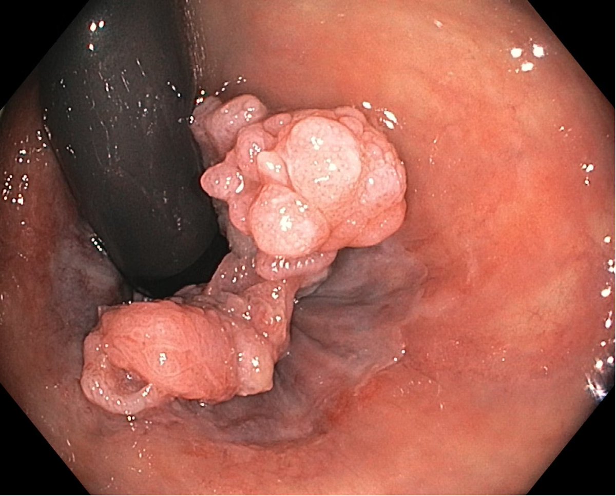 EndoCollab™ | GI Endoscopy Community tweet media