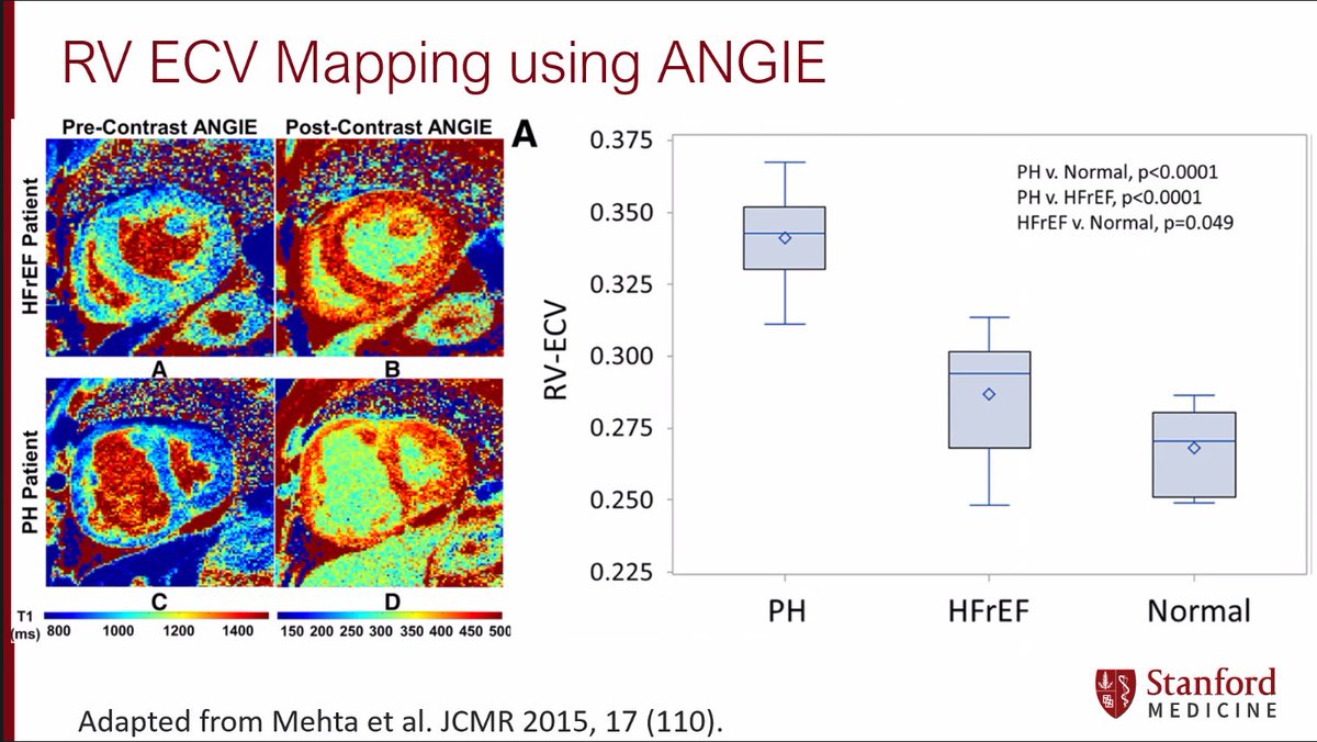 Sarah Cuddy (@sarahcud) on Twitter photo Masterclass in T1 mapping and ECV by <a href="/salernomdphd/">Dr. Michael Salerno M.D. P.h.D</a> at todays <a href="/BWHCVImaging/">Brigham and Women’s Cardiovascular Imaging Program</a> grand rounds👏🏻
🧲checking the quality of the Raw T1 mapping images and motion correction is 🔑 to knowing how robust the mapping data is
🧲ECV of the RV is also possible with dedicated sequences
#whyCMR Masterclass in T1 mapping and ECV by <a href="/salernomdphd/">Dr. Michael Salerno M.D. P.h.D</a> at todays <a href="/BWHCVImaging/">Brigham and Women’s Cardiovascular Imaging Program</a> grand rounds👏🏻
🧲checking the quality of the Raw T1 mapping images and motion correction is 🔑 to knowing how robust the mapping data is
🧲ECV of the RV is also possible with dedicated sequences
#whyCMR