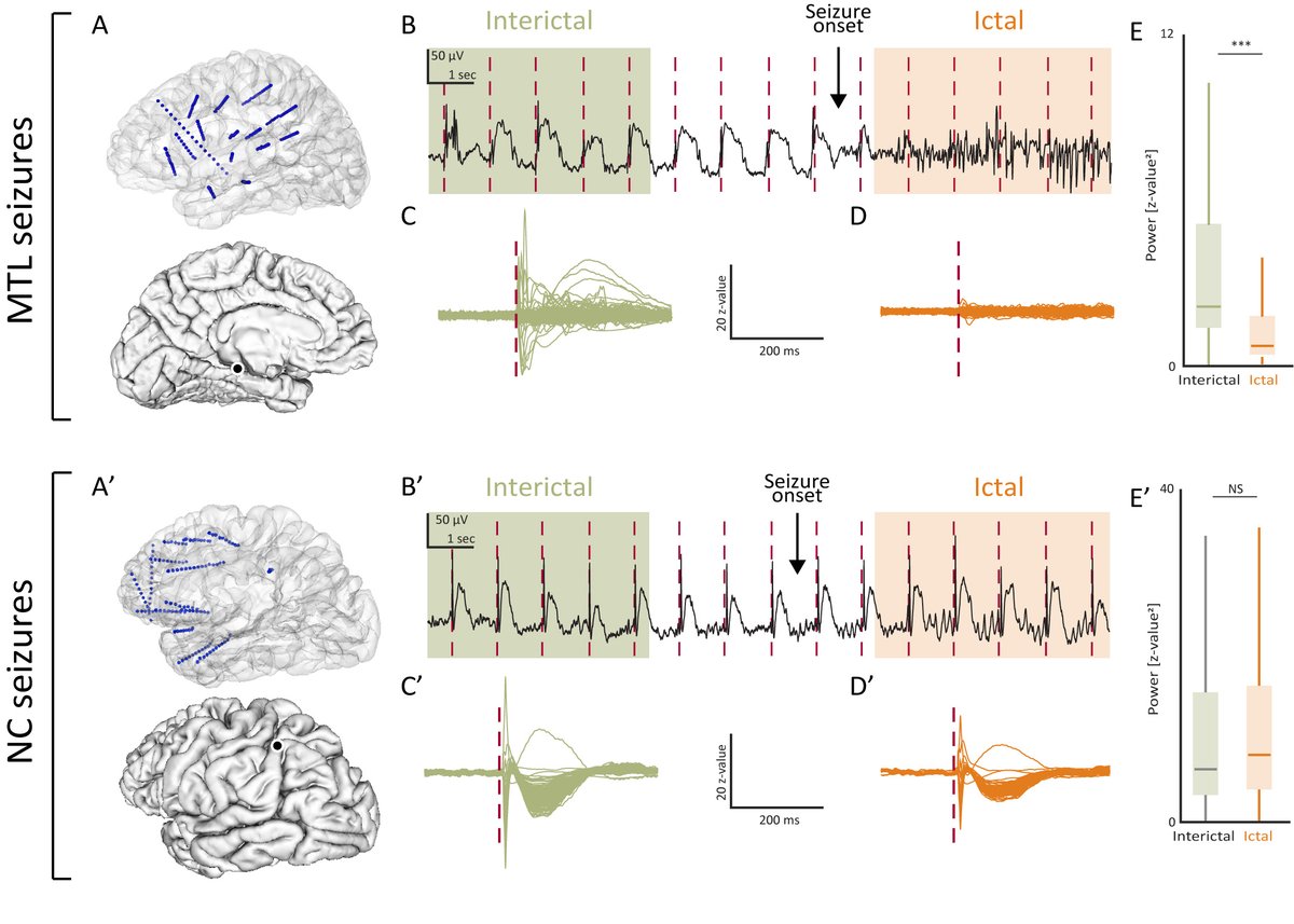 EpilepsiaJourn's tweet photo. Neocortical and medial temporal #seizures have distinct impacts on brain responsiveness
https://t.co/uVfqCZP9mw

 #epilepsy #ILAE #Responsiveness #IntracranialRecording #CorticoCortical #EvokedPotential #TemporalLobe @IlaeWeb  @yesILAE @epilepsiajourn @WileyNeuro https://t.co/7uc7Hi6seX