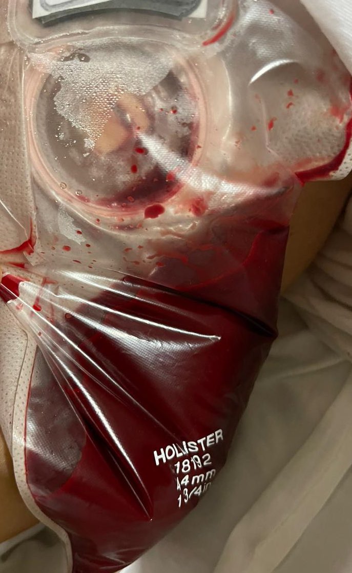 Cirujano preparando maletas para la playa… El drenaje del paciente: “ahhh siiiii?”