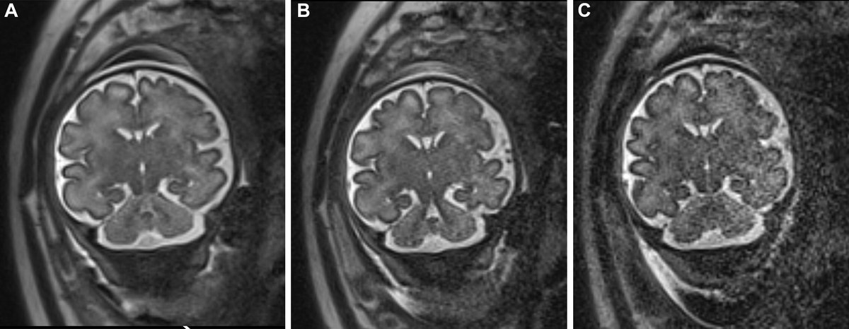 Fetal MRI at 3 T: Principles to Optimize Success

pubs.rsna.org/doi/10.1148/rg…

"The authors condense the cumulative experience of fetal imaging specialists and MRI technologists who practice at a large referral center into a guideline covering all major aspects of fetal MRI at 3 T"