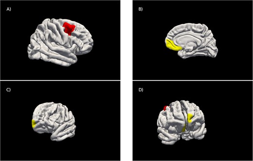 Genetic overlap between cortical brain morphometry and frontotemporal dementia risk. Findings also implicate NSF gene expression in the etiology of FTD. bit.ly/40IZLw0

@LM_garciamarin @durananiotz @YokoyamaLabUCSF @mrenteria_
@RCFNeuro @GBHI_Fellows #NIAfundedADRC