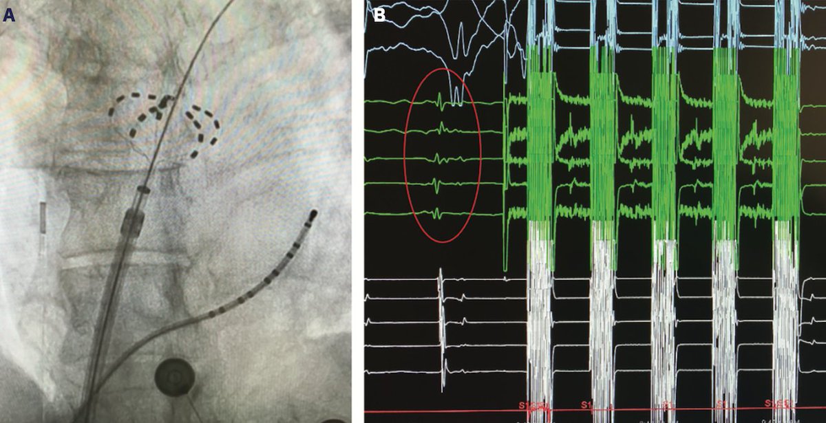 EP Lab Digest (@eplabdigest) on Twitter photo Pulsed Field Ablation for Atrial Fibrillation: Recent Advances and Future Directions
In this review, <a href="/ampatelmd/">Anshul M. Patel, MD</a> discusses the background of #PFA, its use in preclinical and clinical studies, and possible future directions. Read it here: okt.to/9NwVZo Pulsed Field Ablation for Atrial Fibrillation: Recent Advances and Future Directions
In this review, <a href="/ampatelmd/">Anshul M. Patel, MD</a> discusses the background of #PFA, its use in preclinical and clinical studies, and possible future directions. Read it here: okt.to/9NwVZo
