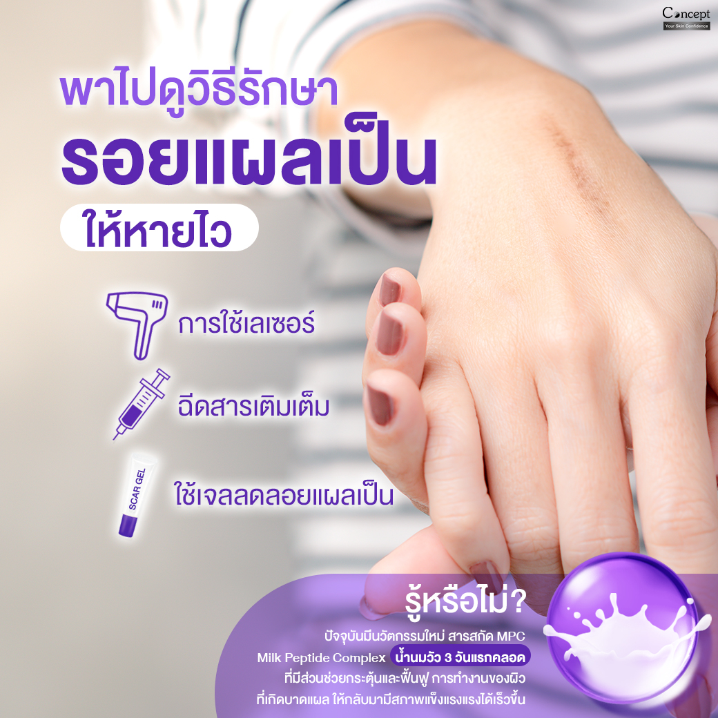 ConceptCream's tweet photo. วิธีรักษารอยแผลเป็นให้หายไว

-การใช้เลเซอร์ เหมาะกับรอยแผลเป็นตื้น

-ฉีดสารเติมเต็ม เพื่อไปทำลายเนื้อเยื่อผิวที่นูนออกให้เรียบขึ้น

-เจลลดลอยแผลเป็นจากสารสกัด Milk Peptide Complex ช่วยลดเลือนรอยแผลเป็น และรอยดำรอยแด

ช้อปได้ที่ Line Shopping https://t.co/0enT520lSj

#รอยแผลเป็น https://t.co/Dvvf8GPGce