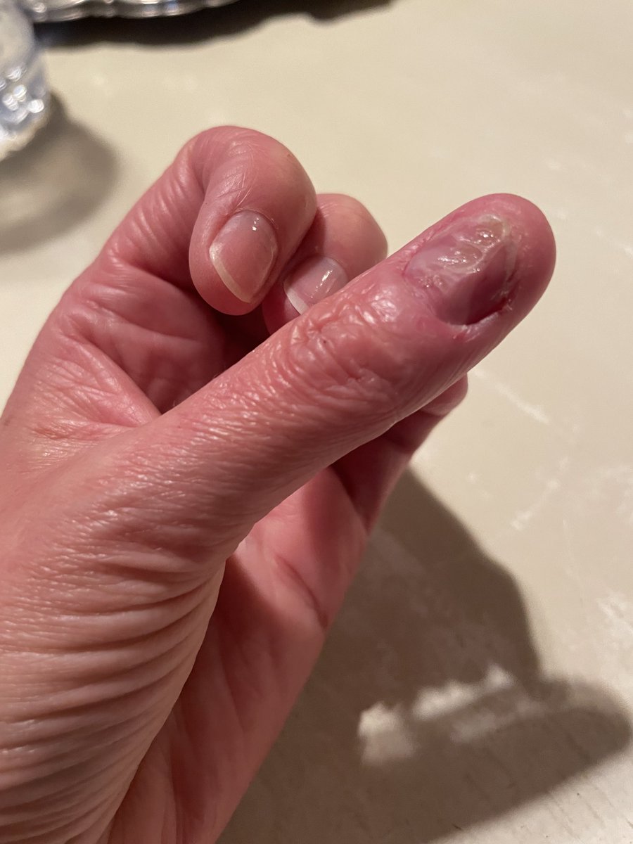 pagetpaget's tweet photo. My fingernails are fine but I’ve been picking my thumb nails terribly. I’m sending this gross pic in case you are also anxious and doing bad stuff. Let’s try to be nicer to ourselves. I know I have to try harder. https://t.co/kpUs7Y98VQ