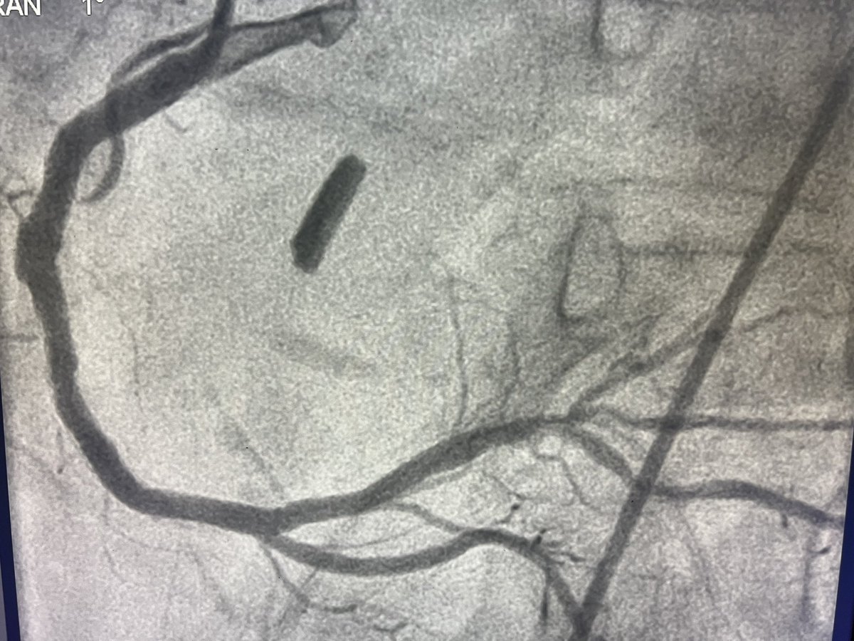 Very Late Stent Thombosis in synergy placed 7 years ago.  Check out the IVUS, I would describe this as late malapposition.  Rx with Cat Rx thrombectomy in the lesion.  TIMI 3 flow established post thrombectomy alone.  Is this due to late malapposition?