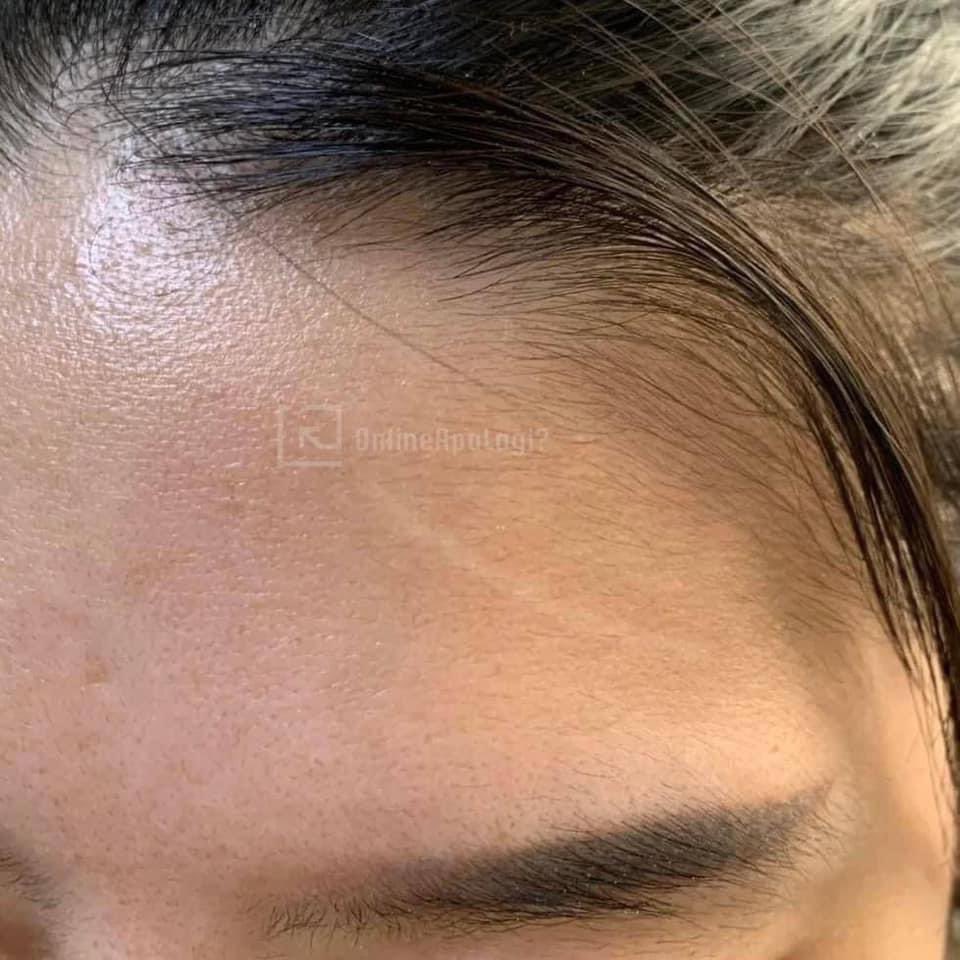 omg! 😱 power nya dermatix ni, kalau korang rasa ada parut yang susah nak hilang tu, boleh try yang ni 👉🏻 shope.ee/qCzXb7mCY