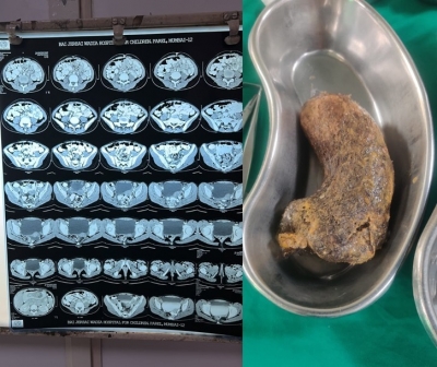 ethonce's tweet photo. Doctors in Mumbai remove a 100 gm "hairball" from a minor girl's stomach
https://t.co/2tWLtWYjV4
In an unusual surgery, doctors removed a 100 gm hairball from the stomach of a 10-year-old girl from Dadar
#ethonce.com  # pain  #Civil #Surgeon small #intestine #Mumbai doctor https://t.co/HGJIFcGu9O