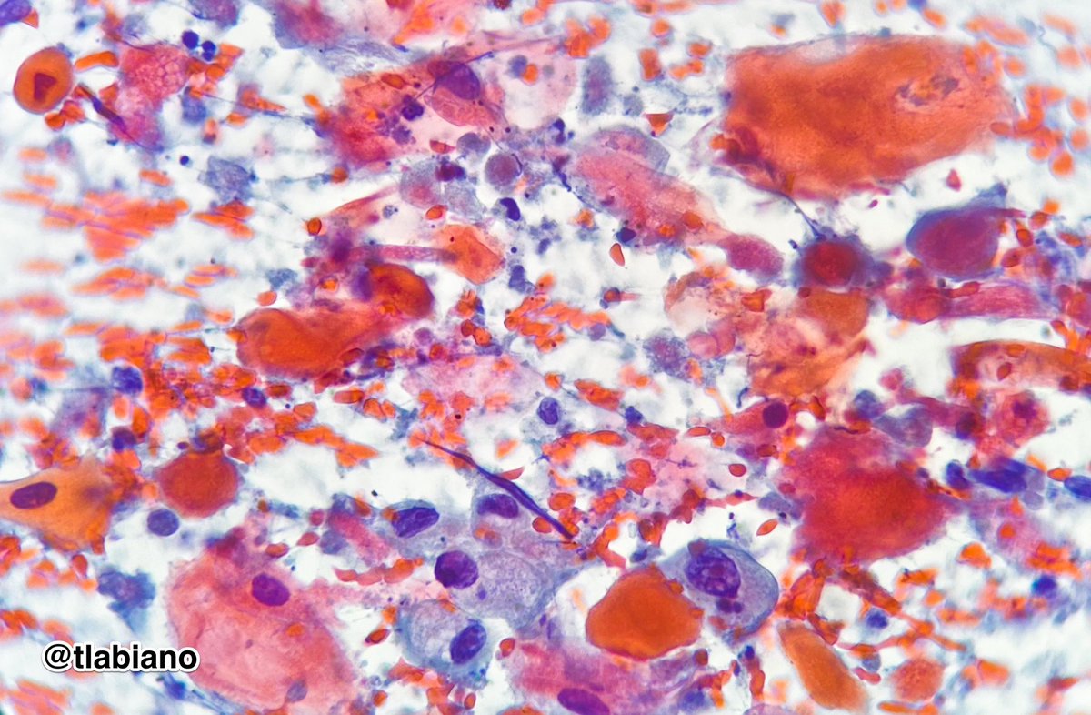 💜🧡❤️Beautiful colours ❤️🧡💜 
Lung Squamous cell carcinoma 
#Cytolovers Have a nice weekend!
🔬☑️ 
 #EBUSFNA #FNAfriday #Cytology #PapStain #Cytopath #orangeophilia
