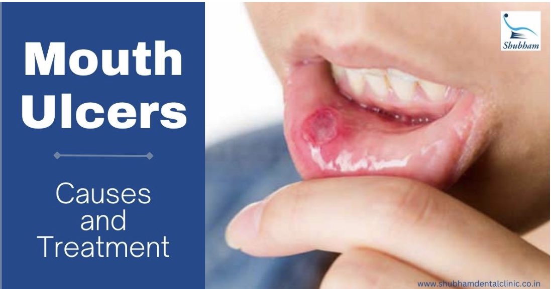 😔 Mouth ulcers are painful, embarrassing, and uncomfortable! 

Find out the various causes of mouth ulcers and how you can avoid your next oral ulcer…read our latest blog
.
shubhamdentalclinic.co.in/mouth-ulcers-c…

#shubhamdentalclinichisar #dentisthisar #dentistnearme #mouthulcers #oralulcers