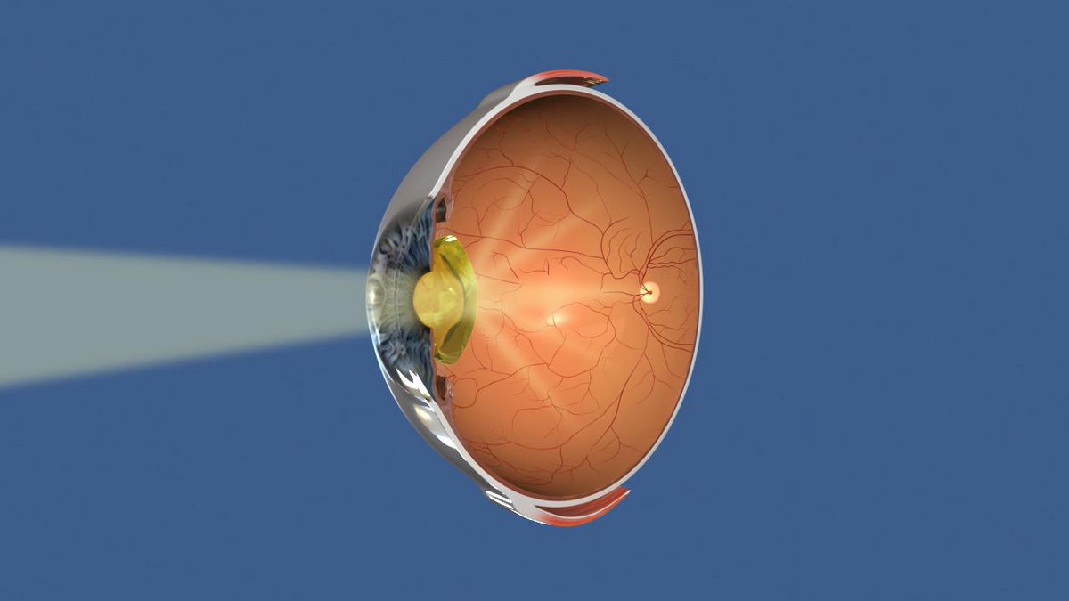 ow.ly/i3Rt104AJWM ow.ly/Q0UQ104ASyZ Recognizing a Cataract in Your Eye - Healthline