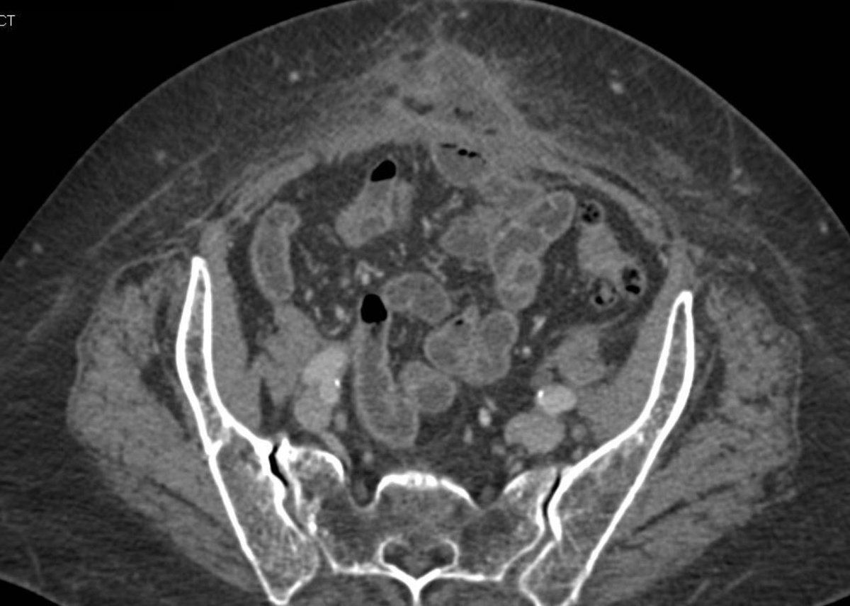 ScottRSteeleMD's tweet photo. #quickcase. On POD2 Following a lysis of adhesions and resection for bowel obstruction you notice green drainage from the midline wound. What’s next? https://t.co/PerX7qnl4t