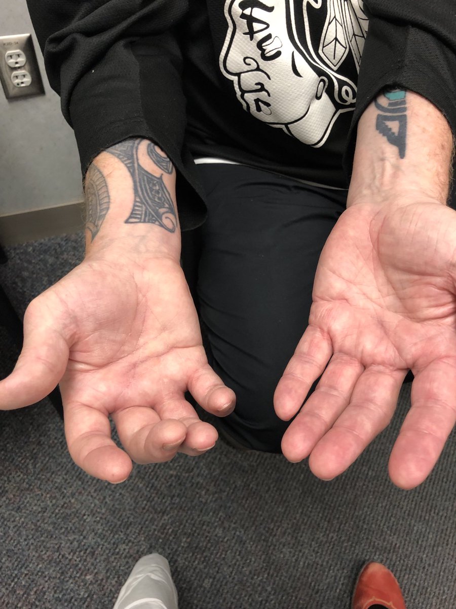 Janetbirdope's tweet photo. #ClinicalPearl Spot #dx Man with recurrent erythema of joint areas with #arthritis and significant #flexor and #extensor #tenosynovitis. Hint occurred in foot previously. #MedEd #MedTwitter https://t.co/W7iP9kZPAG