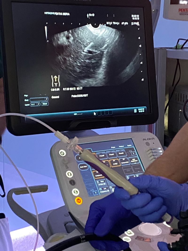 CookMedSurg's tweet photo. Check out Cook's #EUS-guided portal pressure gradient measurement technology!
Photos from another successfully completed #EUSPPG case, this time from our team in Spain 👏 👏 #innovation #GiLiver https://t.co/prAjbSpxD7