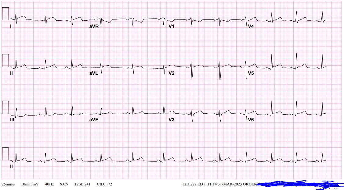 22 years old male with sudden onset unilateral chest Pain. No CAD risk
