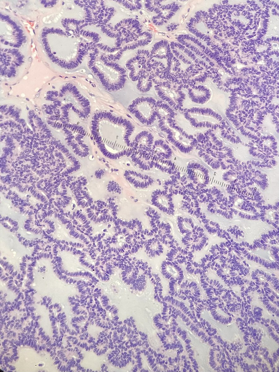 molarsano's tweet photo. Upper lip tumor 65 years old female Two words one start with a C and the second with A. https://t.co/tZnG3JY6IF