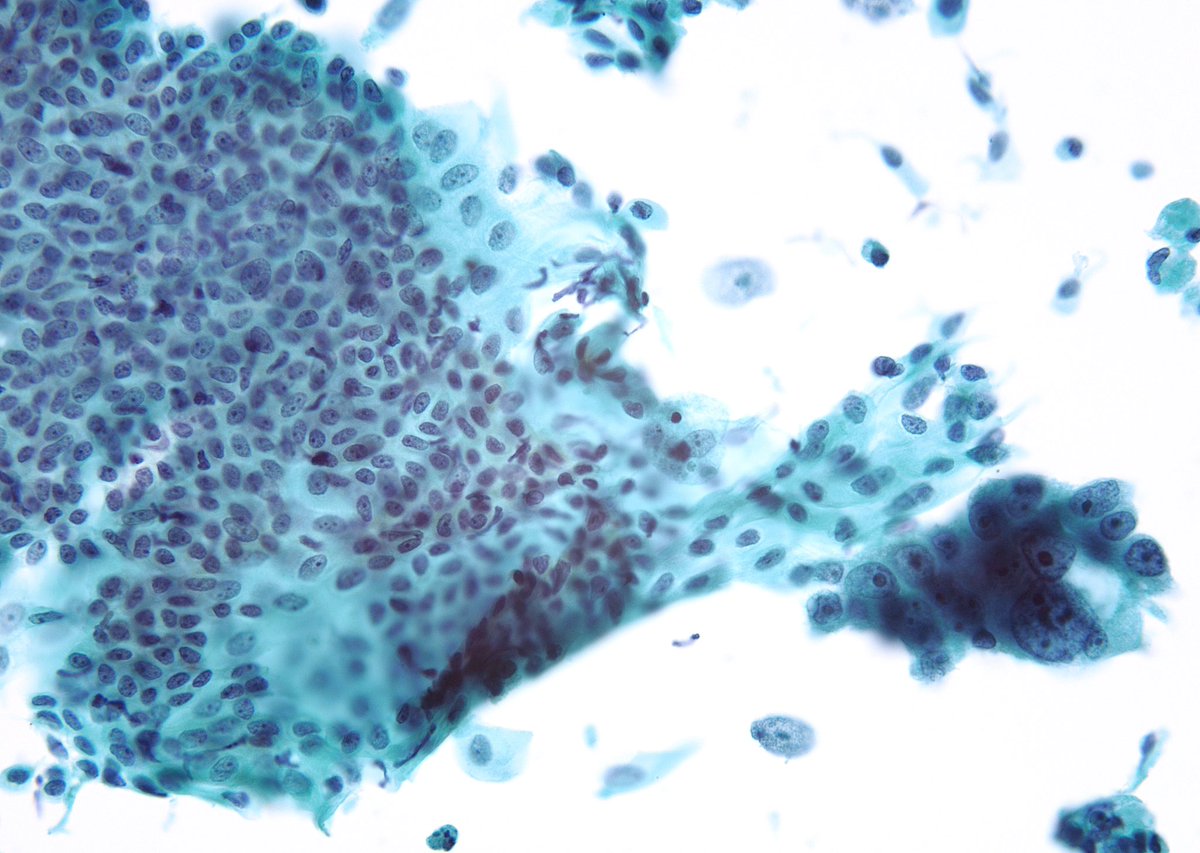 jerad-gardner-md-on-twitter-rt-sza-jhcyto-pap-test-from-a-patient