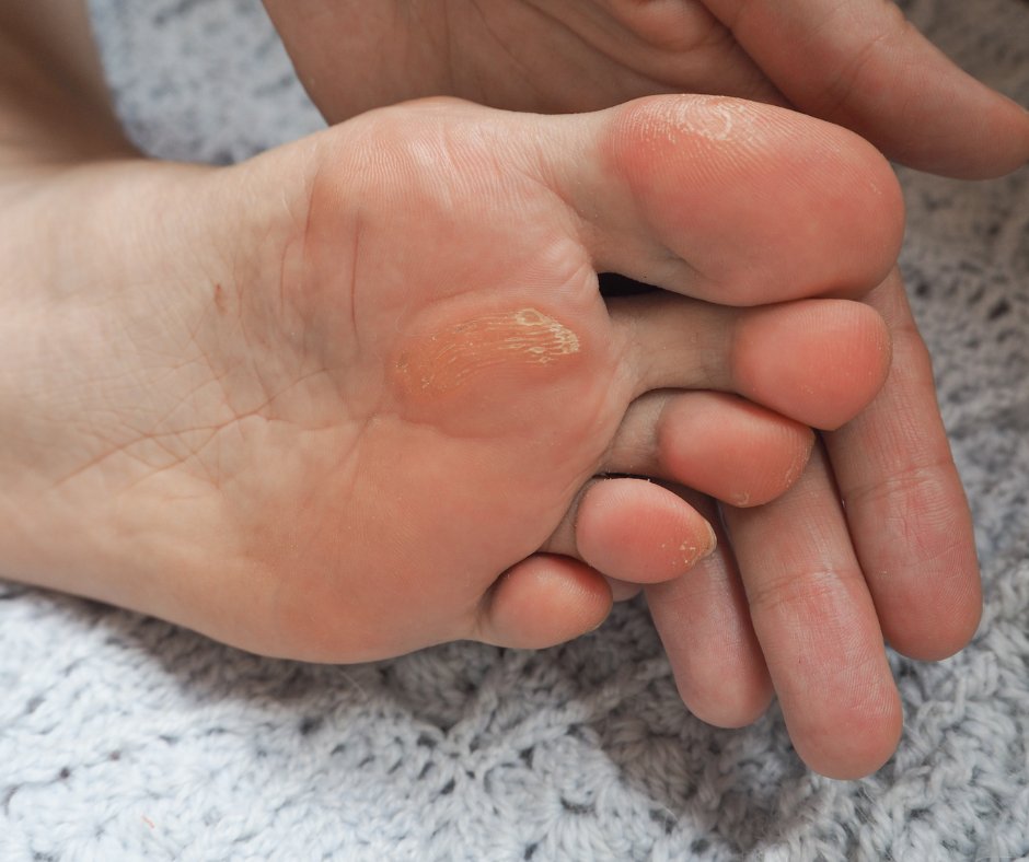 Gapodiatry's tweet photo. We know how frustrating it can be to manage calluses and corns! Skip the at-home treatments and get professional treatment at Georgia Podiatry. Visit our website for more information! https://t.co/TZiXIpfwy5 https://t.co/RkuSyV4tln