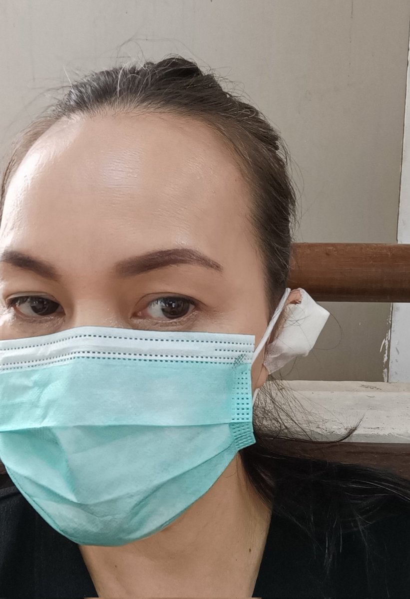 LydiaHermina's tweet photo. Today Maret 31
My 2nd Keloid Removal Surgery ..
#mykeloidremovaljourney
#keloidscar
#earkeloid
#keloid #bpjs https://t.co/E6fagNZOSj