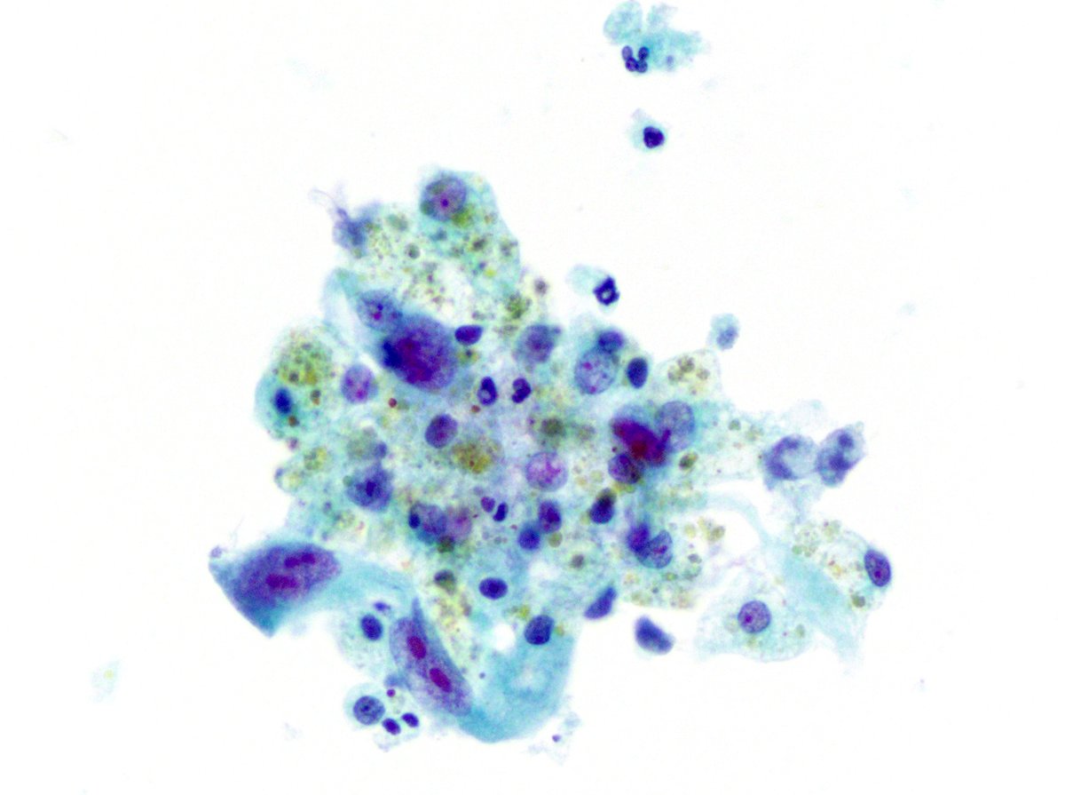 MonicaGarciaBu2's tweet photo. Rhabdomyosarcoma .. bizarre/spindle shaped cells with monster nuclei. @umiamipath #pathresidents #cytology #cytopath #cytolovers #flpath https://t.co/Vq9clTslWZ