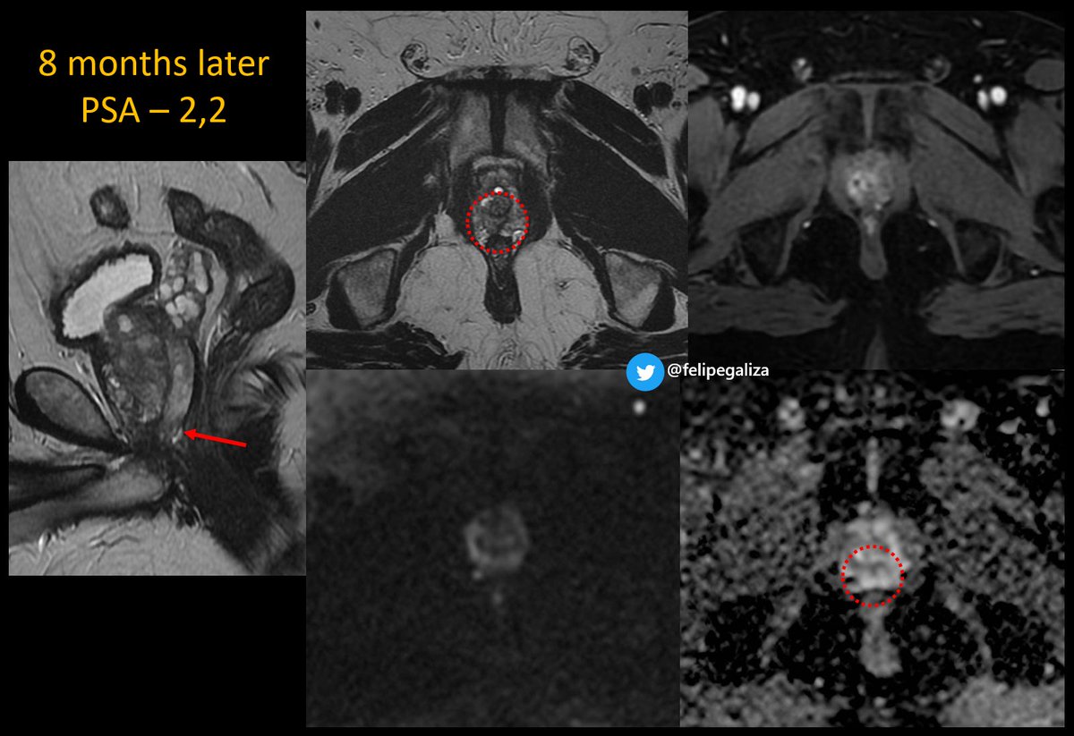 Felipe de Galiza (@felipegaliza) on Twitter photo ⚠️Prostate Cancer Pitfall
58yo - suspicious DRE
Previous Intravesical BCG for UBC
☢️ PI-RADS 4 nodule
🔬Granulomatous Prostatitis (bx proven)
☢️inflammation regression
📝be aware of clinical history (BCG) to consider such differential
#radred #FOAMrad <a href="/SAR_ProstateDFP/">SAR Prostate DFP</a> ⚠️Prostate Cancer Pitfall
58yo - suspicious DRE
Previous Intravesical BCG for UBC
☢️ PI-RADS 4 nodule
🔬Granulomatous Prostatitis (bx proven)
☢️inflammation regression
📝be aware of clinical history (BCG) to consider such differential
#radred #FOAMrad <a href="/SAR_ProstateDFP/">SAR Prostate DFP</a>