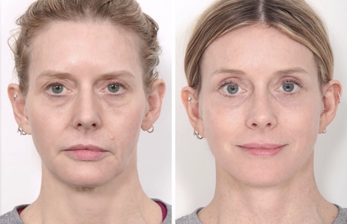 The Cosmetic Lane on Twitter "Deep Plane Facelift, endoscopic brow