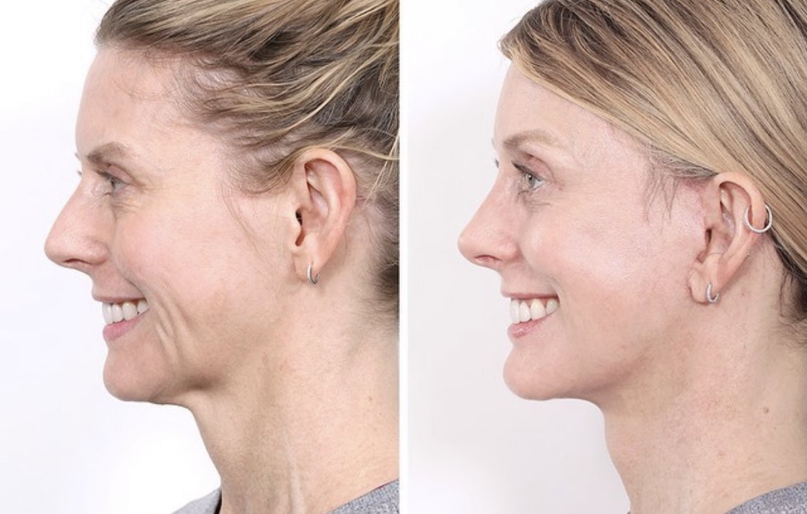 The Cosmetic Lane on Twitter "Deep Plane Facelift, endoscopic brow lift, rhinoplasty, mole