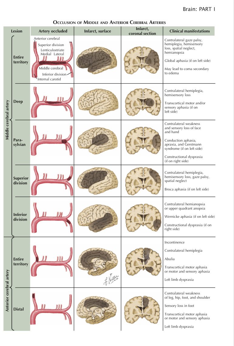 OGdukeneurosurg's tweet photo. Stroke Presentations by vascular territory by Netter https://t.co/e5Q86N2QWY