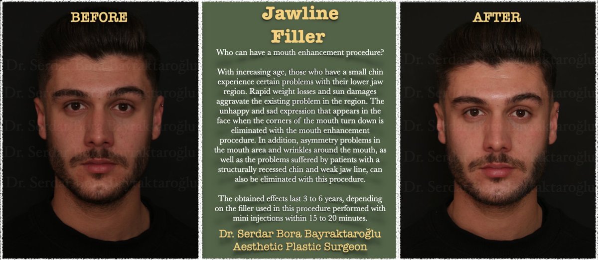 JAWLINE FILLER

#clinicsbb #clinicsbbinternational #aestheticsurgery #plasticsurgery  #plasticsurgeon #serdarborabayraktaroglu #beforeafter #filler #jawline #jawlinefiller #new #aesthetic