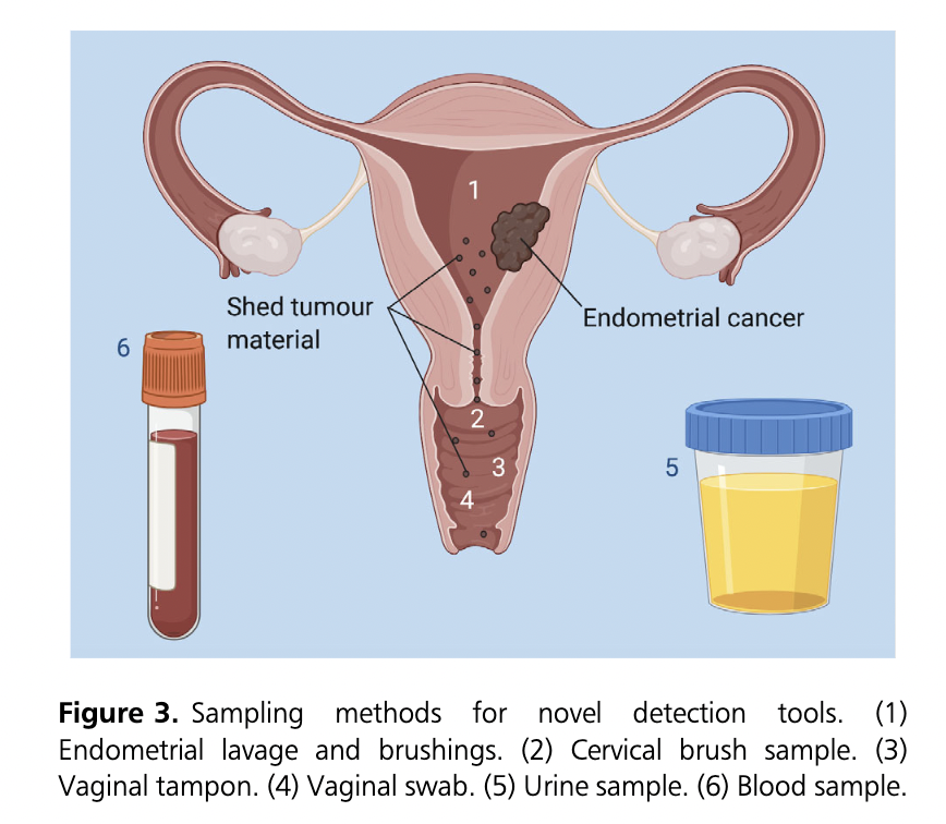 Oooh! Our #TOG review article on detecting #endometrial #cancer received enough downloads to be a #topdownloadedarticle @WileyHealth, @DrEleanorJones @DrHelenaOFlynn @DrKC_Njoku! 
An exciting time for novel non-invasive endometrial cancer detection tools!
obgyn.onlinelibrary.wiley.com/doi/epdf/10.11…