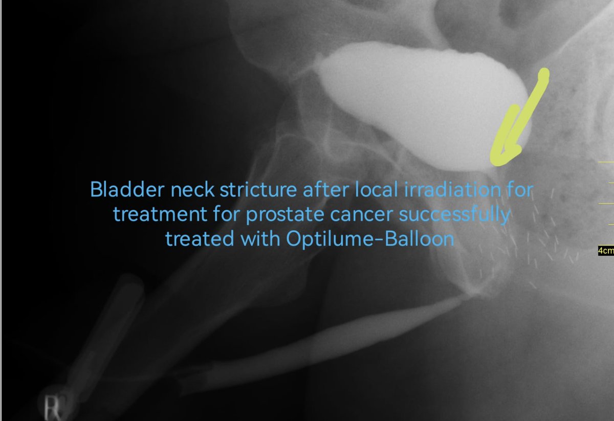 OTosev's tweet photo. Successfully treated bladder neck stricture (after local irradiation treatment of prostate cancer) with #Optilume-Balloon performed by https://t.co/Kp4p9GaadA.univ.Georgi #Tosev. https://t.co/x2kQs2H3a7