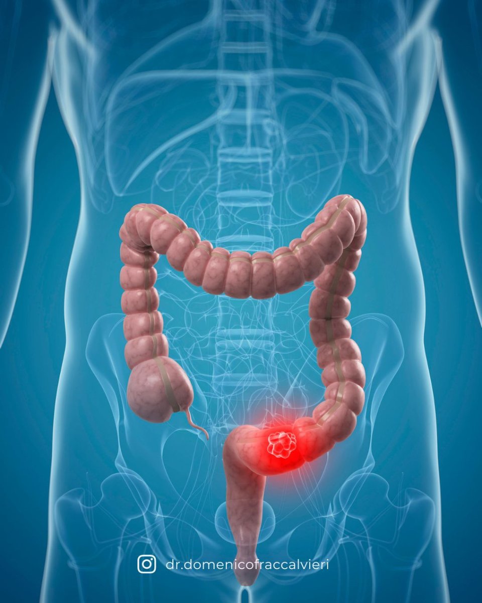 Hoy, 31 de marzo, conmemoramos el Día Mundial del Cáncer de Colon, un día destinado a crear conciencia sobre esta enfermedad y la importancia de su prevención y detección temprana. El cáncer de colon es uno de los tipos de cáncer más comunes.
#cáncer
#cáncercolorectal
#prevención