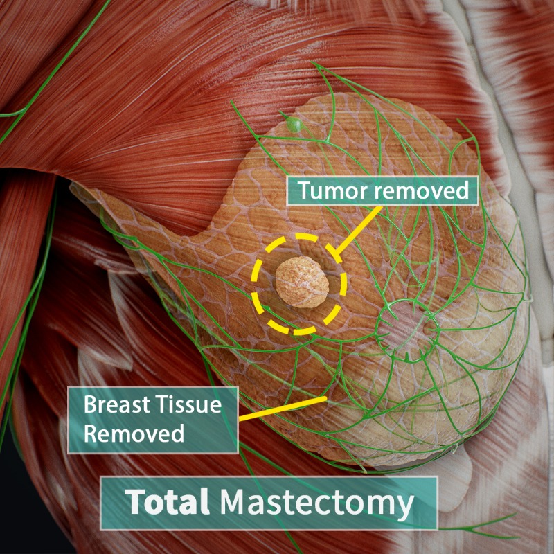 CompleteAnatomy's tweet photo. A mastectomy is a procedure or surgery where the breast or breasts are removed. This may sometimes include other tissues as well such as lymph nodes that are near the breast tissue. Learn about the types of mastectomy in our latest #AnatomySnippet #CompleteAnatomy