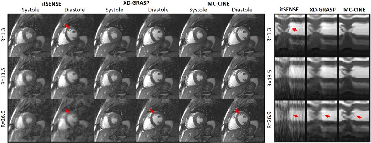 Interested in single-heartbeat cine? Check it out @ …iencejournals.onlinelibrary.wiley.com/doi/abs/10.100…