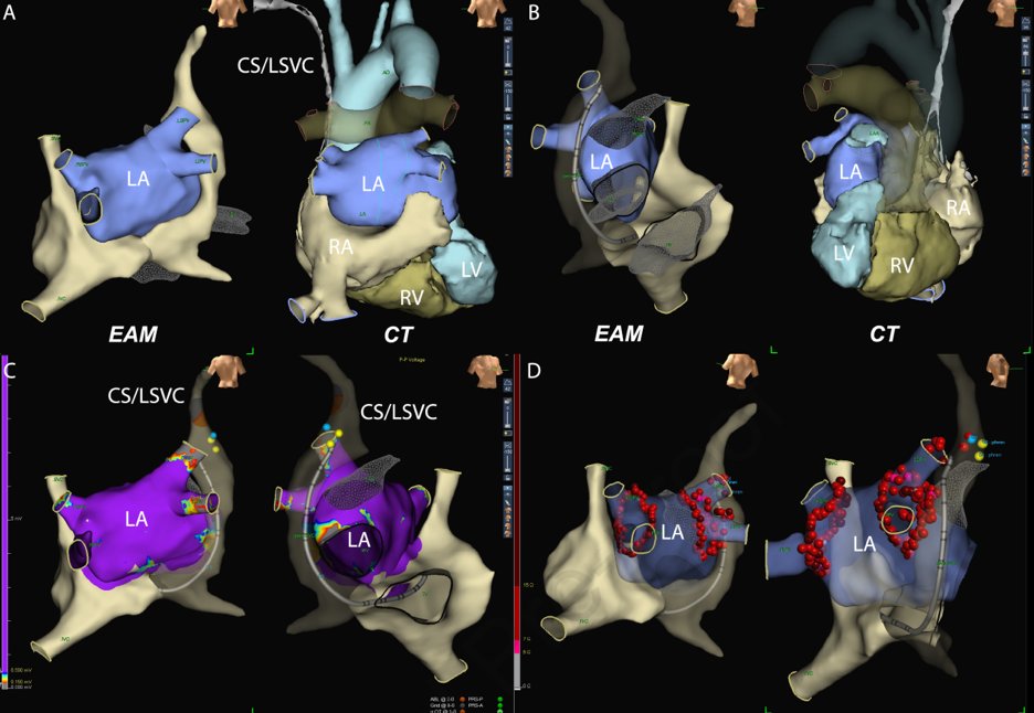NEW @HRS_CaseReports! Just another day in the #EPeeps lab doing #afib ablation in pt w/ dextrocardia, situs inversus, interrupted IVC, persistent L-sided SVC.

Huge team effort 🙏 @svTri24, Kei Yamada, @alanhanley2

Link: bit.ly/dextro_pvi

@MGHHeartHealth @MassGeneralNews