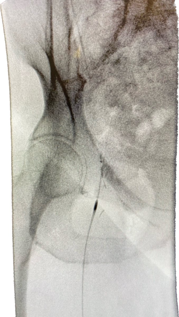 sorinmedicalny's tweet photo. Dr. Justin Ratcliffe was the first in NY to use CSI’s new 2.00 Max Orbital Atherectomy Device.
#sorinmedicalny #cardiology #Interventionalcardioloigy #medical #PAD #CSIsponsered #orbitalatherectomy #CLI #alternativeaccess #pedalaccess #radialaccess #angioplasty https://t.co/AIcJe0Kvn5