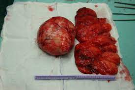 JedCalunsag's tweet image. Which among the ff. is/are a tumor marker/s
A. Cortisol
B. Calcitonin
C. ADH
D. AOTA