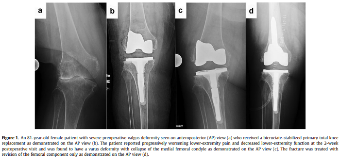 HSS_ARJR_CJRC's tweet photo. Be sure to check out our #snfcjrc peer-reviewed #revisionpaperofthemonth entitled Early Femoral Insufficiency Fractures After Primary Total Knee Arthroplasty
Great work Dr. Tarity!
https://t.co/Wv7mIjOmvI
#orthotwitter #complexjoint #rTKA #MedEd #revision https://t.co/JVv7YtRoSy