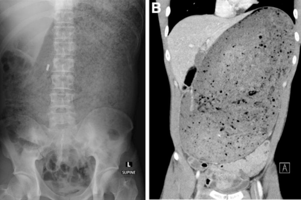 A 30-year-old presented to ED with abdominal pain &amp; distension hours after a competitive SPEED EATING event where the patient consumed a 7 pound burger in 30 minutes. thoughts?