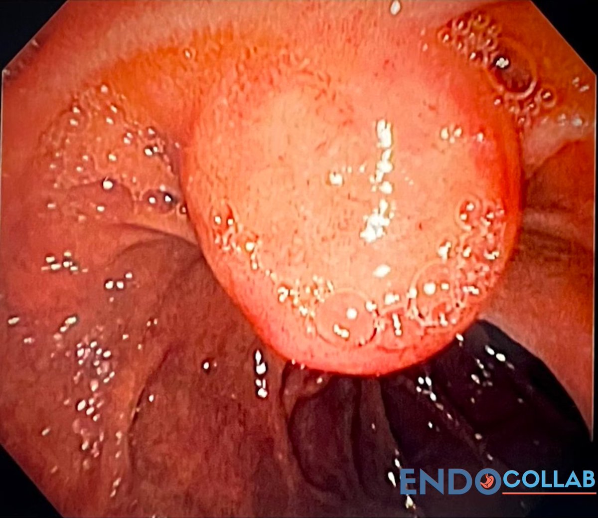 EndoCollab™ | GI Endoscopy Community tweet media
